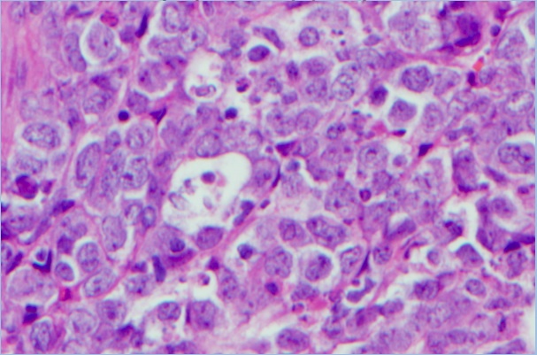 High power view of paraspinal mass biopsy.  Sections show lymphoblast infiltration that are intermediate in size with fine chromatin, irregular nuclear contours, and scant cytoplasm.  Numerous tingible body macrophages are seen.